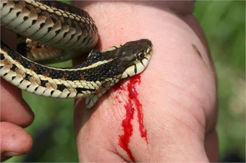 the severity of a snakebite