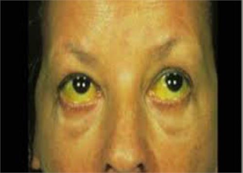 jaundice disease specific treatment