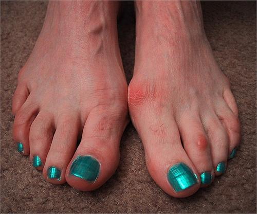 with these easy ways sores on feet