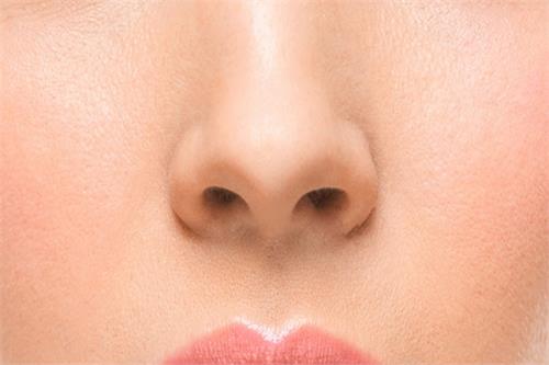 these home remedies follow to correct phinasiam on the nose