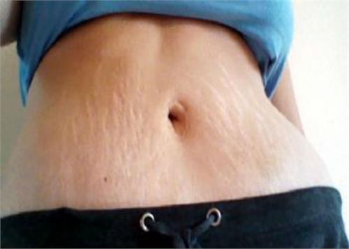 bring after delivery in the size of the stomach so
