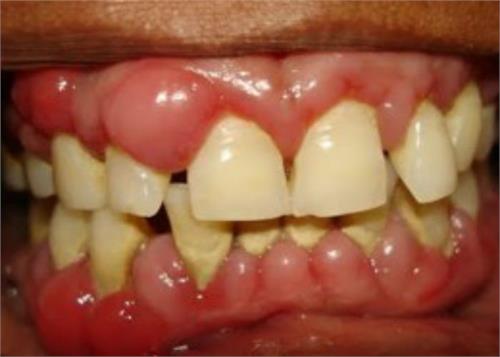 to ease the gum swelling apanao prescription