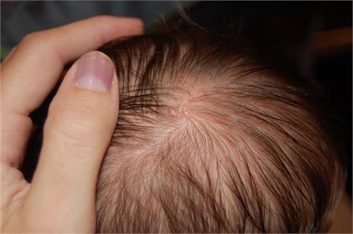 soon get rid of the fort in the head skin