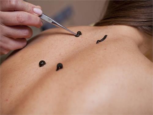 how is leech therapy beneficial