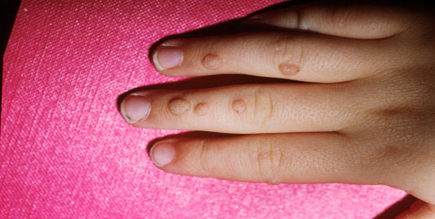 adopt students with home remedies to get rid of mahukia