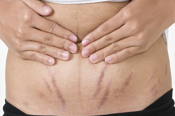 stretch mark removal easier and domestic measures