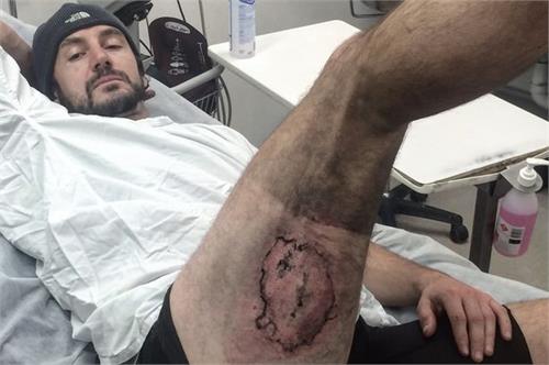 apple iphone 6 explodes man injured