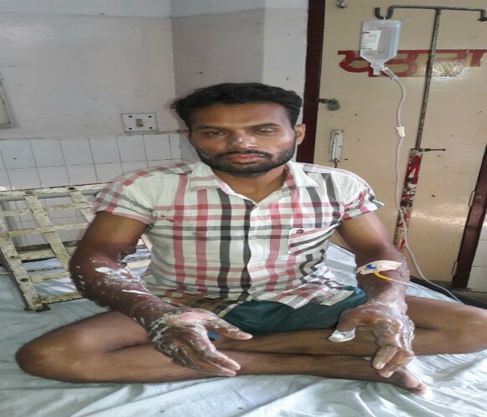 ਦੁੱਧ ਗਰਮ ਕਰਦੇ ਸਮੇਂ ਫਟਿਆ ਸਟੋਵ, ਭਾਂਬੜ ਮਚਣ ਨਾਲ ਝੁਲਸੇ ਪਤੀ-ਪਤਨੀ