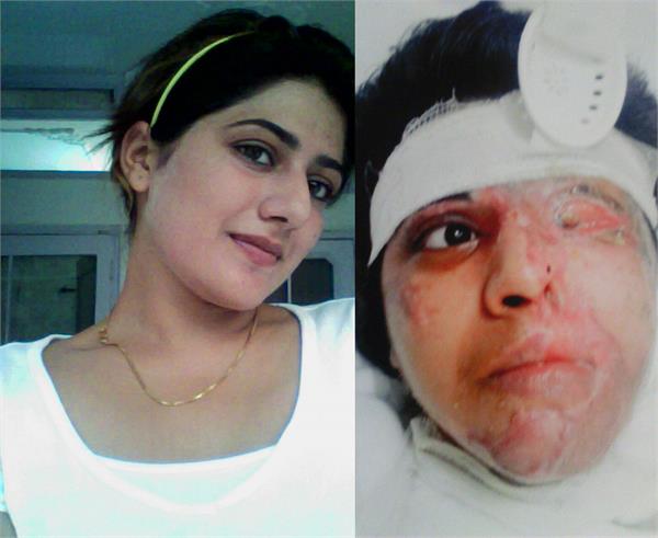 acne victims did not get medical examination for four years
