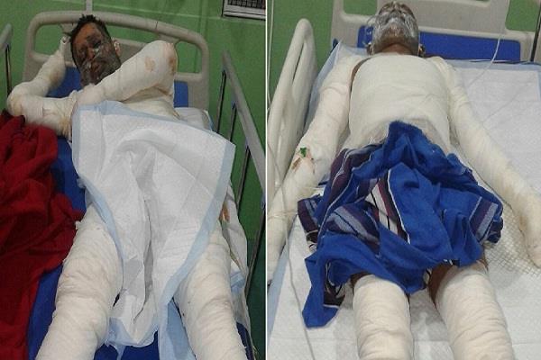 heavy fires  18 laborers injured and 2 critical condition in oil mill