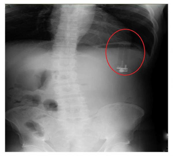 1 year  stomach  pain  x ray  truth  front