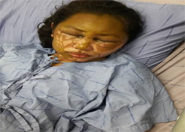 acid attack video viral on girlfriend by ex girlfriend