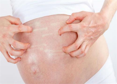 itchy during pregnancy