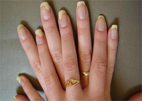 nails home remedies to get rid of mold