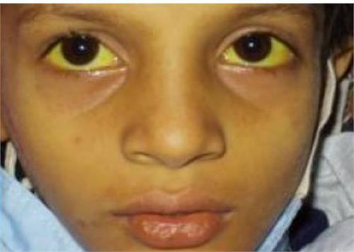 apanao home remedies to get rid of jaundice disease