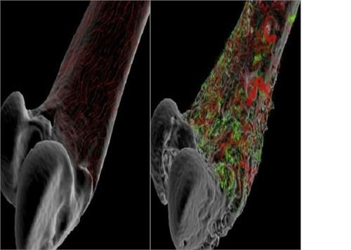 these are the symptoms and reasons of bone cancer