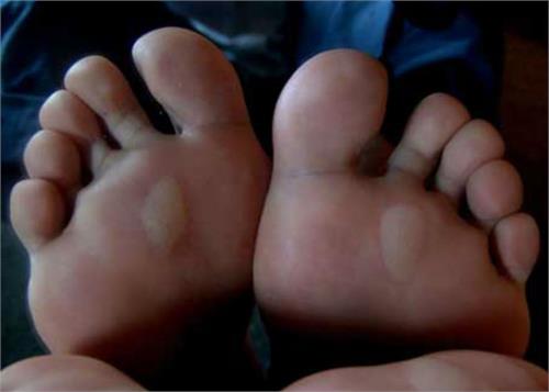 just follow these easy ways to overcome the foot fungus and sores