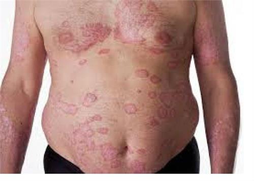 make psoriasis treatment live better life