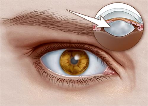 use these measures to reduce cataract