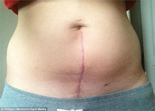 unique case  the 22 year old boy pulled out of the stomach  cervix