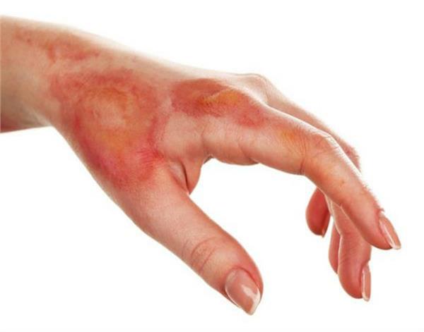 use any of these methods after burning any part of the body to relieve pain 