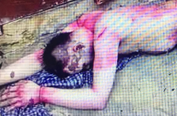 ਇਟਲੀ ਤੋਂ ਆਇਆ ਨੌਜਵਾਨ ਪੈਟਰੋਲ ਨਾਲ ਜਲਿਆ