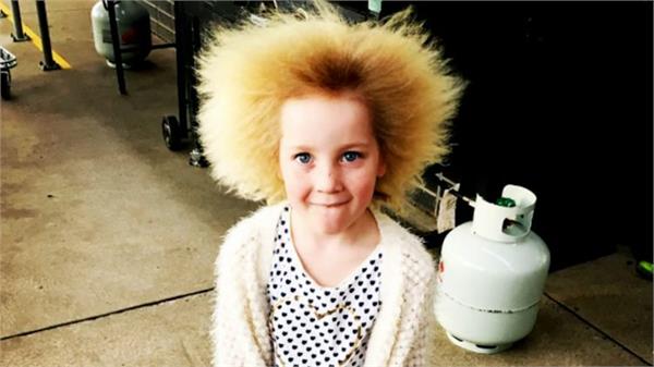 girl suffers from uncombable hair syndrome
