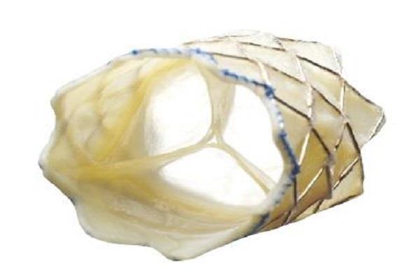 after stent  the heart valve can be 50 percent cheaper