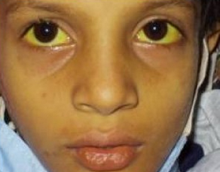 ਪੀਲੀਏ ਦੇ ਰੋਗ ਨੂੰ ਦੂਰ ਕਰਨ ਲਈ ਇਨ੍ਹਾਂ ਘਰੇਲੂ ਨੁਸਖਿਆਂ ਦੀ ਕਰੋ ਵਰਤੋ