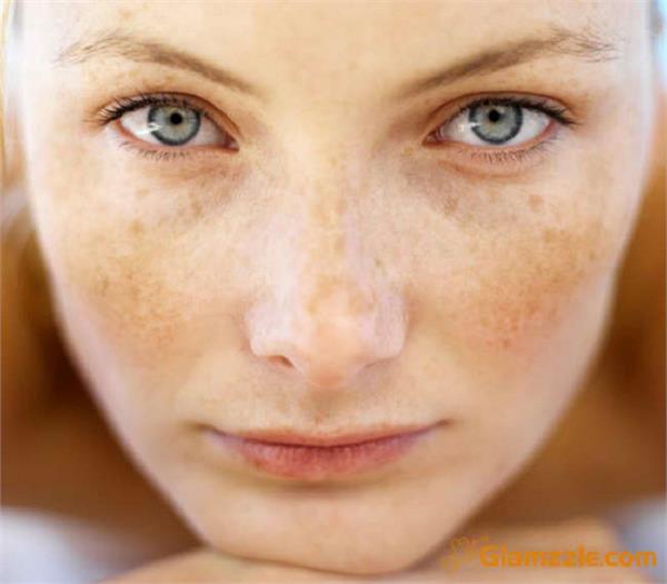 blemishes