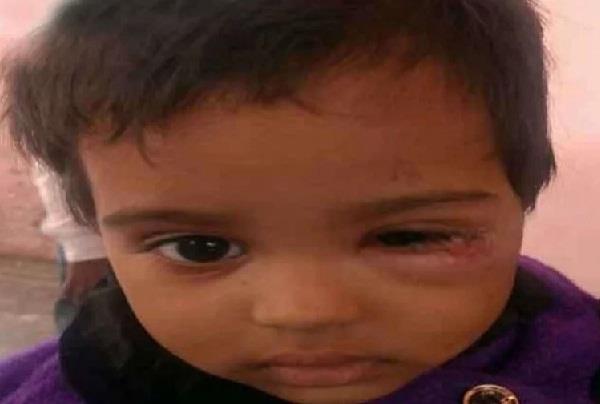 husband beat wife for dowry and burn child eye