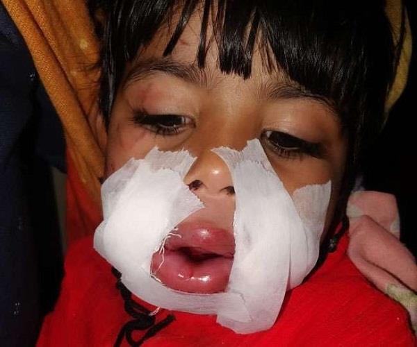 meerut boy sets off cracker inside 3 year old girl s mouth