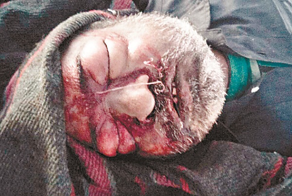 ਜ਼ੇਰੇ ਇਲਾਜ ਪ੍ਰਵਾਸੀ ਮਜ਼ਦੂਰ ਦੀ ਮੌਤ