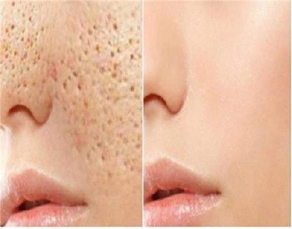 turn off facial openings in just 3 days