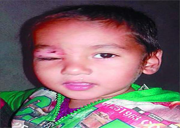 stray dogs  children  injured