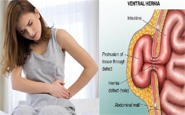 if you are also disturbed by hernian  s problem