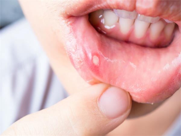 use this home remedies to solve the problem of ulcers