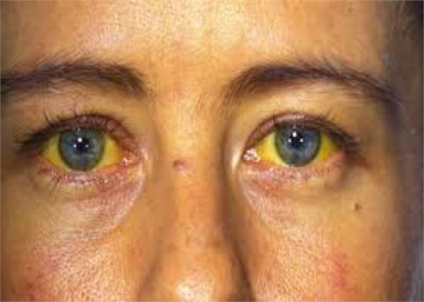 jaundice disease