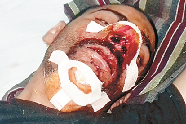 ਪੌੜੀਆਂ ਤੋਂ ਪੈਰ ਫਿਸਲਣ ਕਾਰਨ ਹਵਾਲਾਤੀ ਜ਼ਖਮੀ