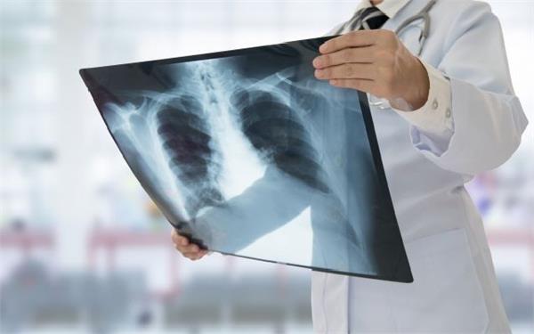 many doctors in india miss tb signs  study