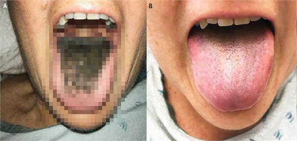 american woman gets hair on the tongue due to antibiotics