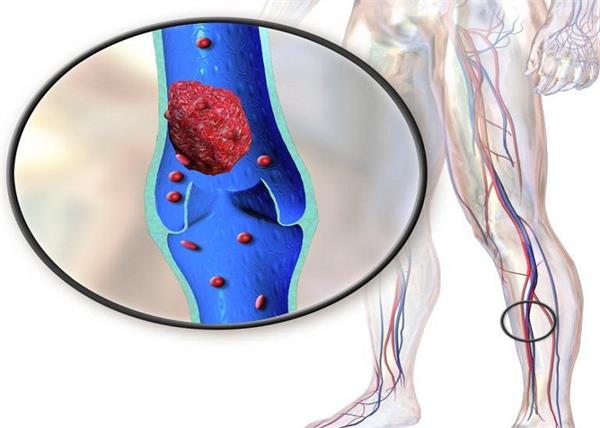 uk  blood clot