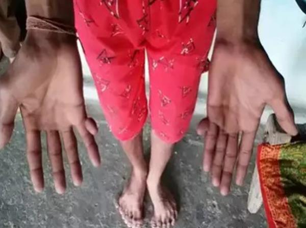 more than 10 fingers of hands and feet cause trouble