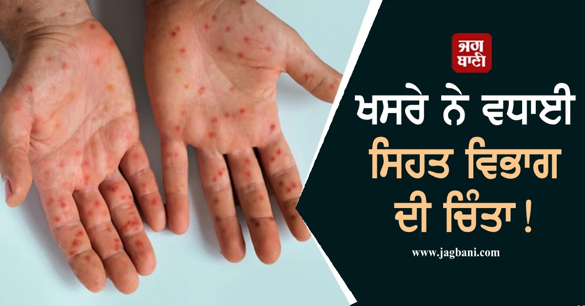 ਅਚਾਨਕ ਸਾਹਮਣੇ ਆਏ 850 ਤੋਂ ਵਧੇਰੇ ਮਾਮਲੇ! ਖਸਰੇ ਨੇ ਵਧਾਈ ਸਿਹਤ ਵਿਭਾਗ ਦੀ ਚਿੰਤਾ