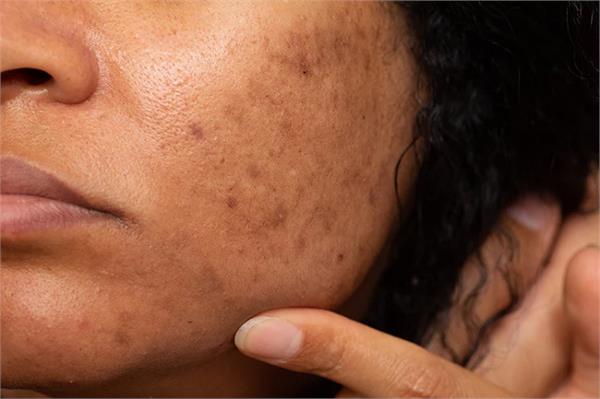 acne  vitamin c  capsules  serum