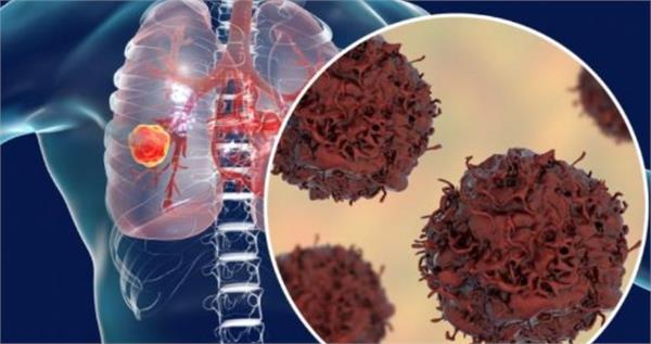 lung cancer is increasing due to air pollution