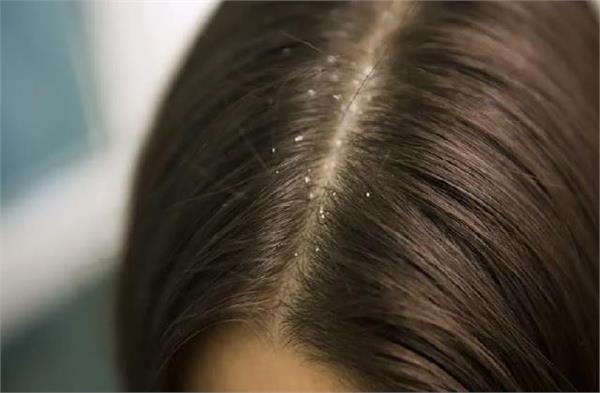 winter  dandruff  weather  skin  home remedies