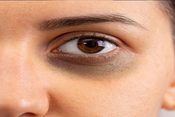 ਵਿਟਾਮਿਨ ਦੀ ਕਮੀ ਜਾਂ ਨੀਂਦ ਦੀ ਘਾਟ? ਜਾਣੋ ਅੱਖਾਂ ਹੇਠਾਂ ਕਾਲੇ ਘੇਰੇ ਬਣਨ ਦੇ ਮੁੱਖ ਕਾਰਨ