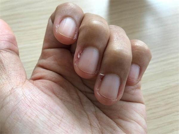 nails  skin  hangnails  treatment