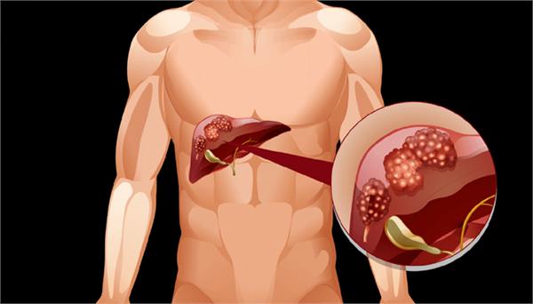 liver cancer is increasing rapidly in the world